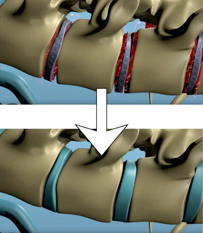 Nubax Traction - Back Stretcher / Spinal Decompression – Autletix